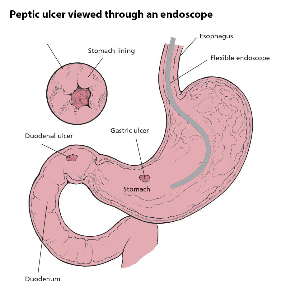 Can A Stomach Ulcer Affect Your Throat